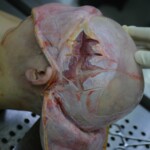 Autopsy of stabbed girl