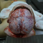 Autopsy of stabbed girl