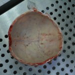 Autopsy of stabbed girl