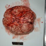 Autopsy of stabbed girl