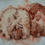 Autopsy of stabbed girl