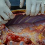 Autopsy of stabbed girl