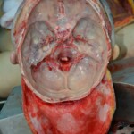 Autopsy of stabbed girl