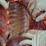 Autopsy of stabbed girl