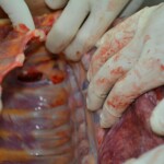 Autopsy of stabbed girl