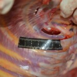 Autopsy of stabbed girl