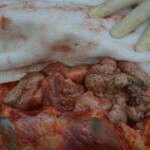 Autopsy of stabbed girl