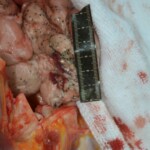 Autopsy of stabbed girl