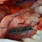 Autopsy of stabbed girl