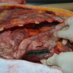 Autopsy of stabbed girl