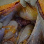 Autopsy of stabbed girl