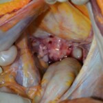 Autopsy of stabbed girl