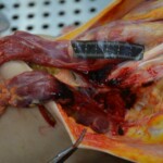 Autopsy of stabbed girl