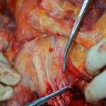 Autopsy of stabbed girl