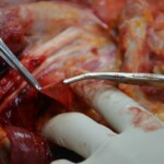 Autopsy of stabbed girl