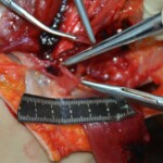 Autopsy of stabbed girl