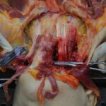 Autopsy of stabbed girl