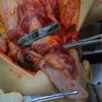 Autopsy of stabbed girl