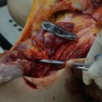 Autopsy of stabbed girl