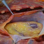 Autopsy of stabbed girl