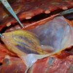 Autopsy of stabbed girl