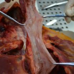 Autopsy of stabbed girl