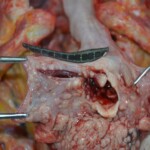 Autopsy of stabbed girl