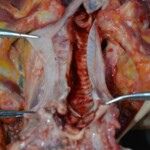 Autopsy of stabbed girl