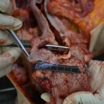 Autopsy of stabbed girl