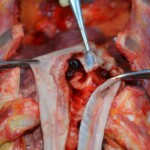 Autopsy of stabbed girl