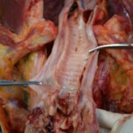 Autopsy of stabbed girl