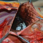 Autopsy of stabbed girl