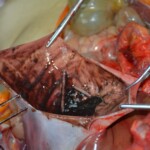 Autopsy of stabbed girl