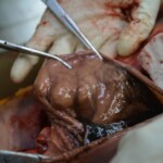 Autopsy of stabbed girl