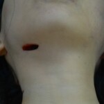 Autopsy of stabbed girl