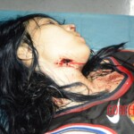 Stabbed teenage girl