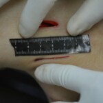 Autopsy of stabbed girl