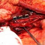 Autopsy of stabbed Chinese girl