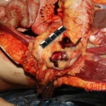 Autopsy of stabbed Chinese girl