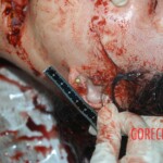 Autopsy of young girl