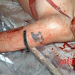 Autopsy of young girl