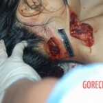 Autopsy of young girl