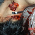 Autopsy of young girl