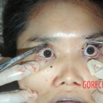 Autopsy of young girl