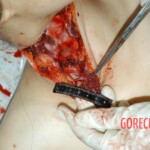 Autopsy of young girl