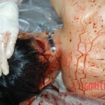 Autopsy of young girl