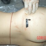 Autopsy of young girl