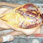 Autopsy of young girl