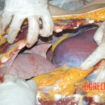 Autopsy of young girl
