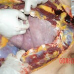 Autopsy of young girl